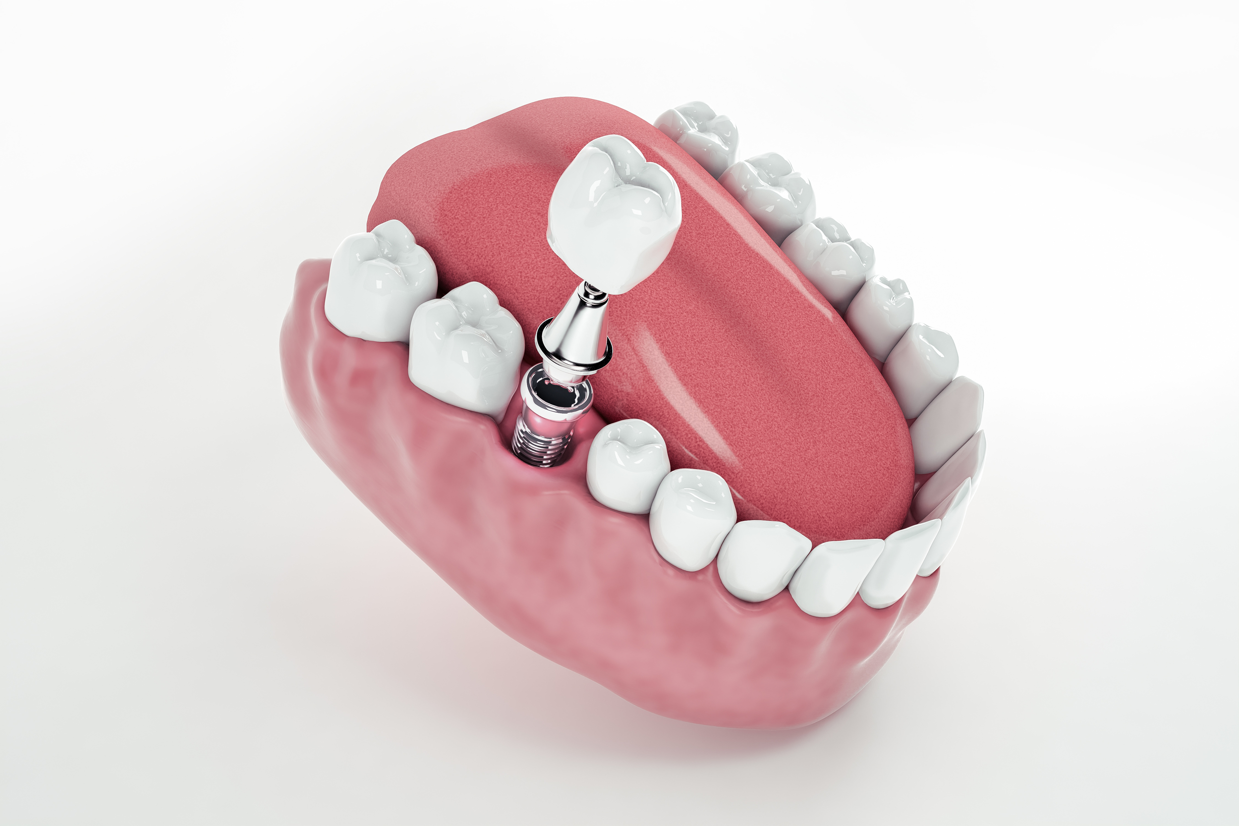 View from above of a false tooth implant fixed in the jawbone; 3D; 3D Illustration